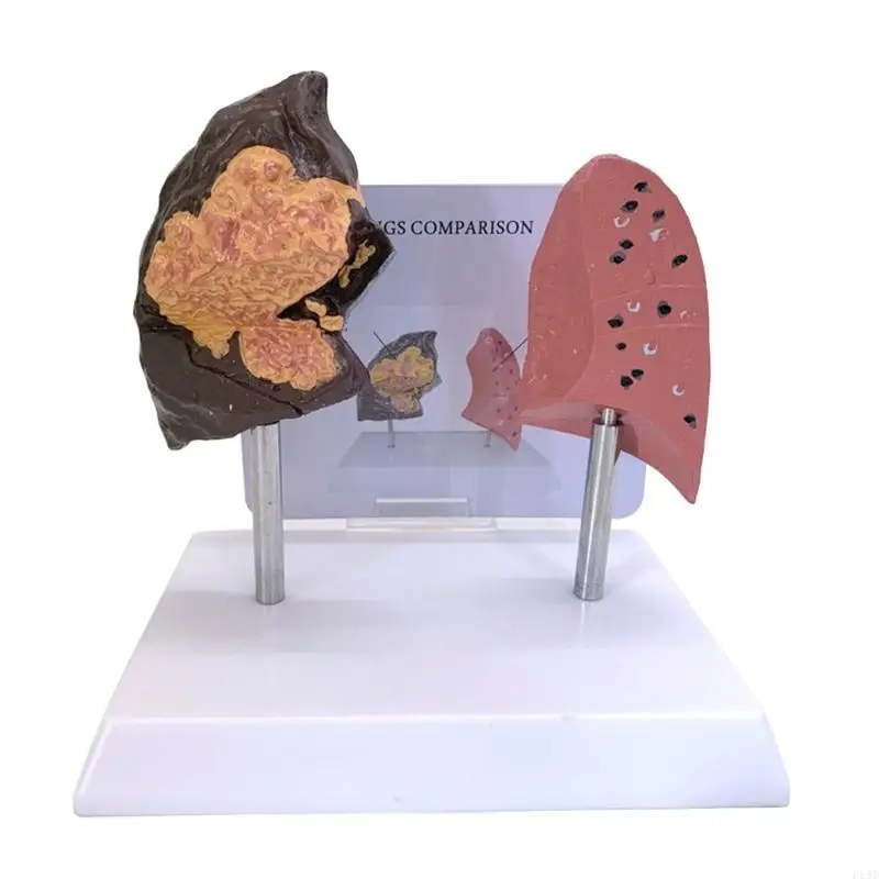 نفخة الرئة مقابل الرئة الصحية نموذج مقارن للتعليم السريري أداة تعليمية هيكل PVC الدائم F19E