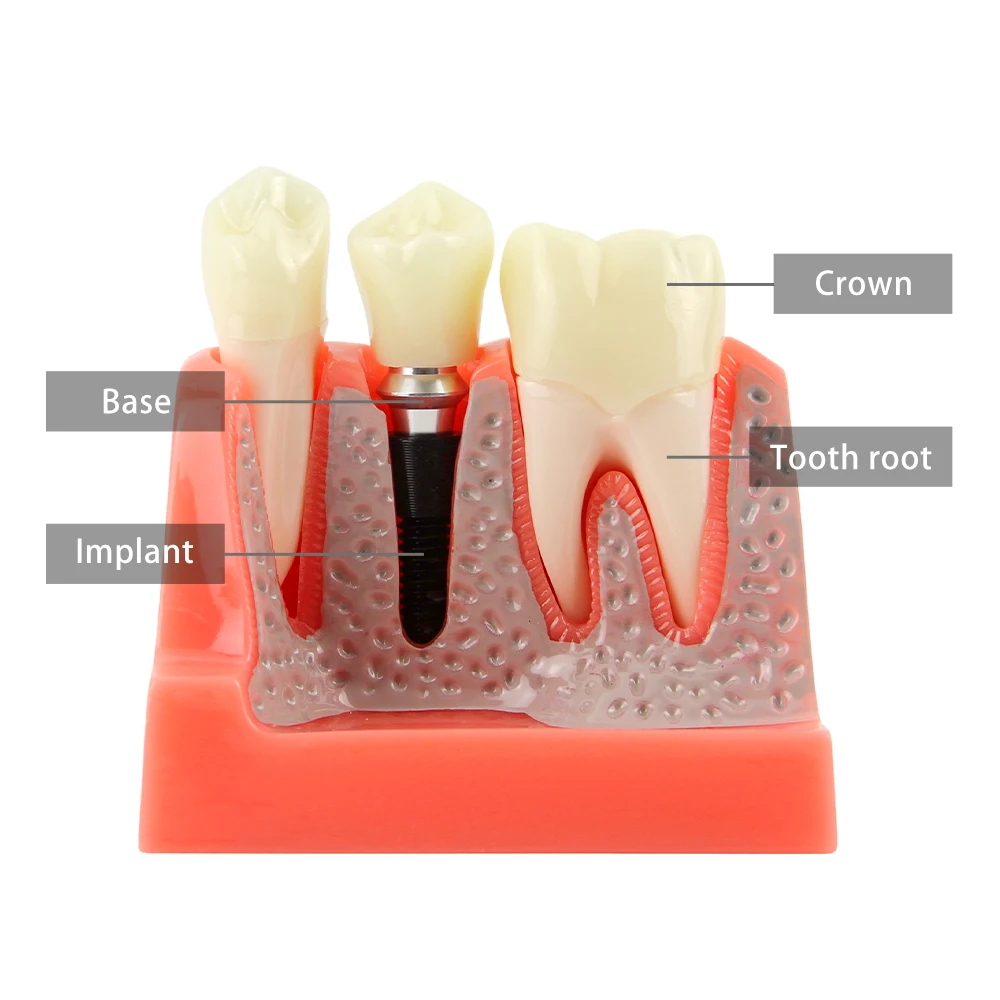 

4X Dental Implant Teeth Model Dentisty Study Training Teaching Model Removable Training Study Dental Model
