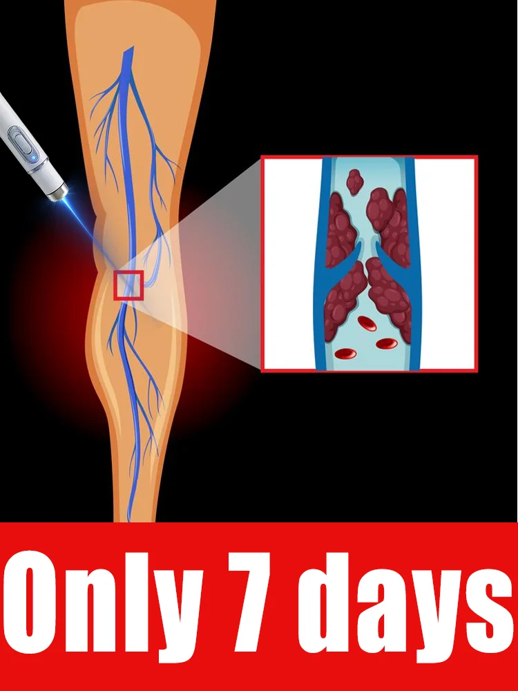 

Vᴀʀɪᴄᴏsᴇ ᴠᴇɪɴ ʟᴀsᴇʀ ɪɴsᴛʀᴜᴍᴇɴᴛ