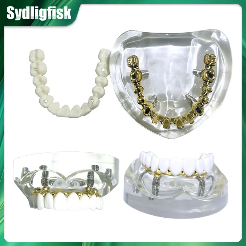 Dental Model Implant Restoration Model Maxillary Removable Overdenture over-restored teeth Model Dental Oral Teaching Research