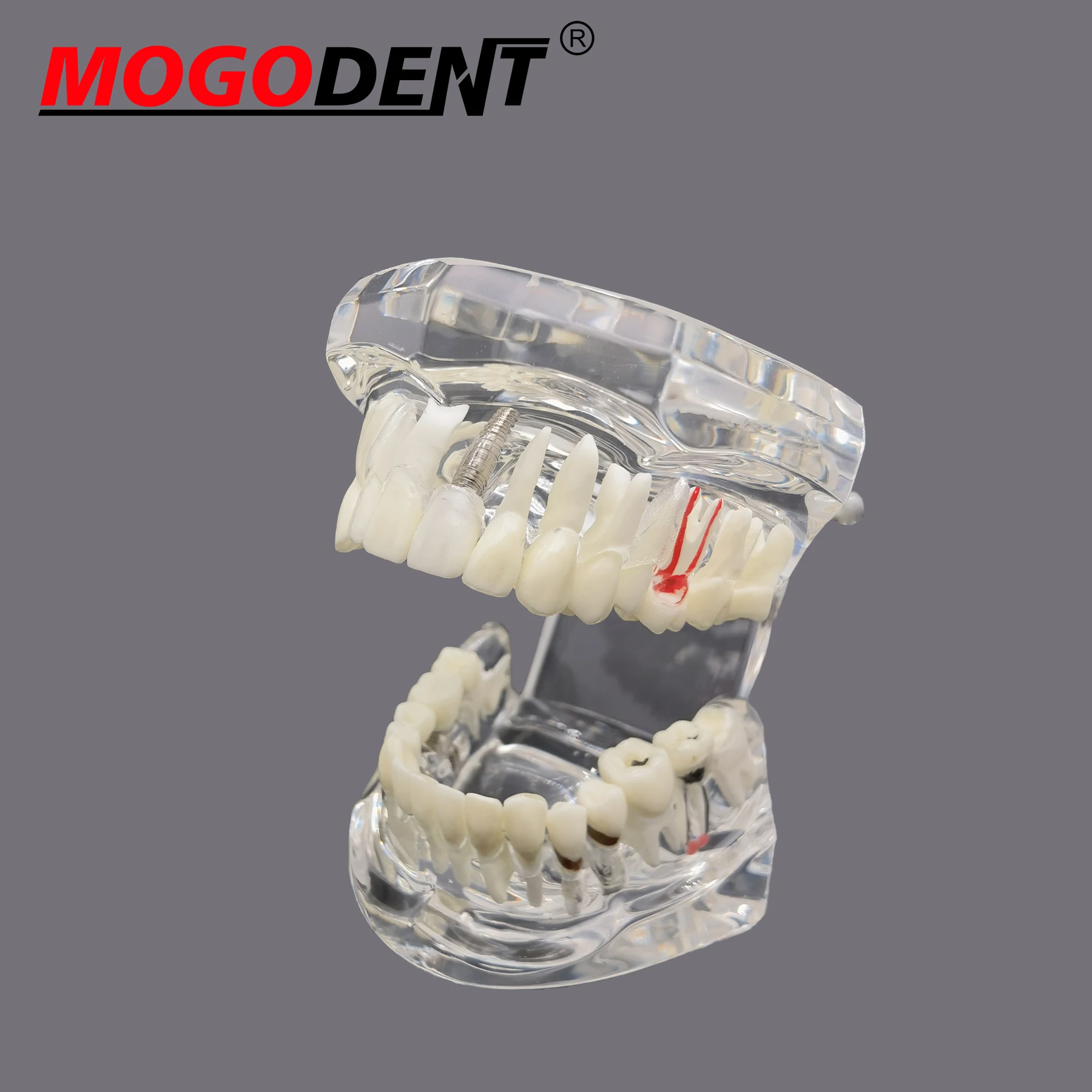 Tooth Model Dental Teaching Models Doctor Patient Communication Teeth Implant Model Dental Resin Tooth Eental Model Dental Lab