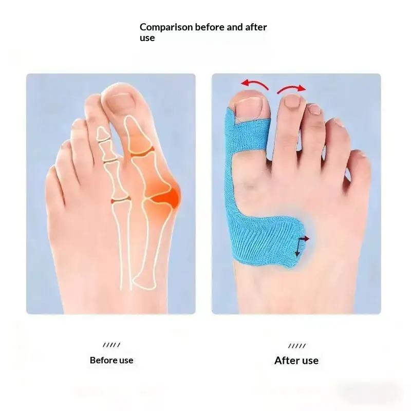 10 Stück hypoallergenes, latexfreies, vorgeschnittenes Kinesiologie-Tape zur Korrektur von Hallux valgus und zur Schmerzlinderung bei den großen Zehen. – Detail 9