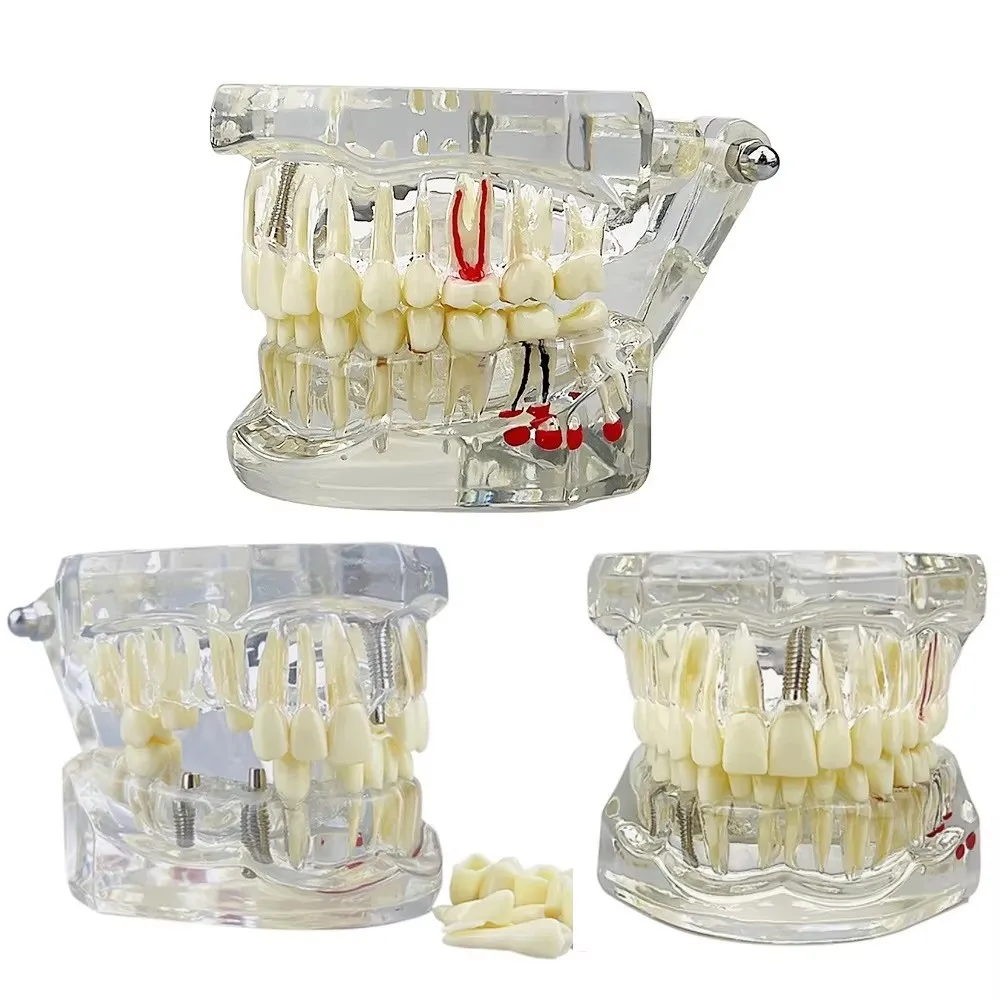 Teeth Model Implant Disease Dentist Studying Model With Restoration Bridge Tooth Demonstration Models For Patient Education