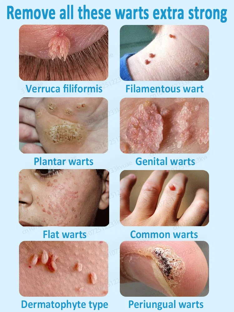 จัดการผิวอย่างปลอดภัย หมดปัญหาเรื่องหูดอีกต่อไป