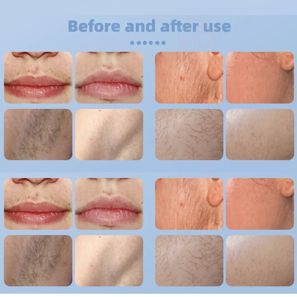 Tragbare Eiskühlung 808 Diodenlaser Schmerzlose Haarentfernung 10 Bars Laser Hautverjüngung Permanenter Epilierer Schönheitsausrüstung