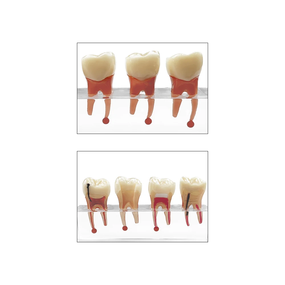 แบบจำลองทางพยาธิวิทยาของฟันสำหรับโมดูลทันตกรรมการสาธิตวิทยาศาสตร์ทางการแพทย์รูปแบบการเรียนการสอนโรค