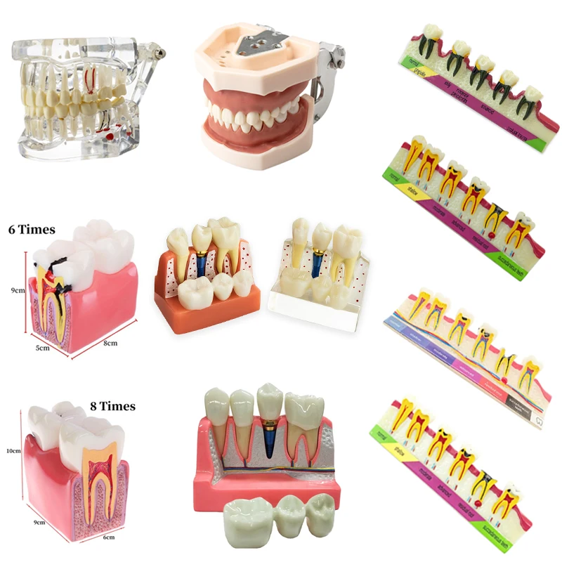 

1Pcs Dental Model Implant Restoration Pathological Tooth Model Dental Teaching Study Demo Dentist Training Removable Teeth Model