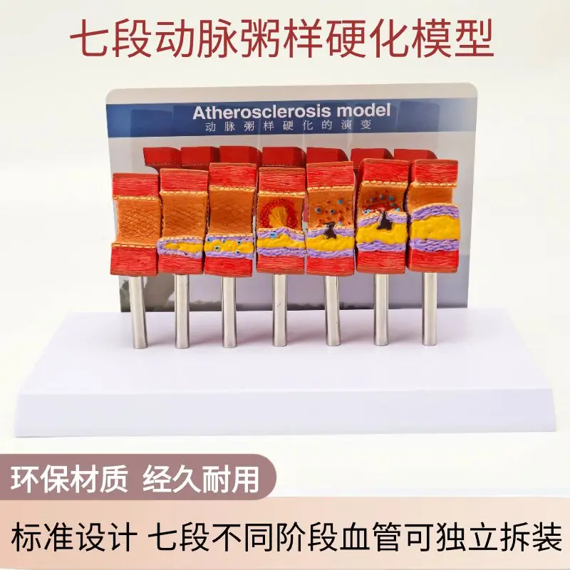 Human Medical Teaching Model Atherosclerosis Model Vascular Thromboembolism Model Arterial Vessel