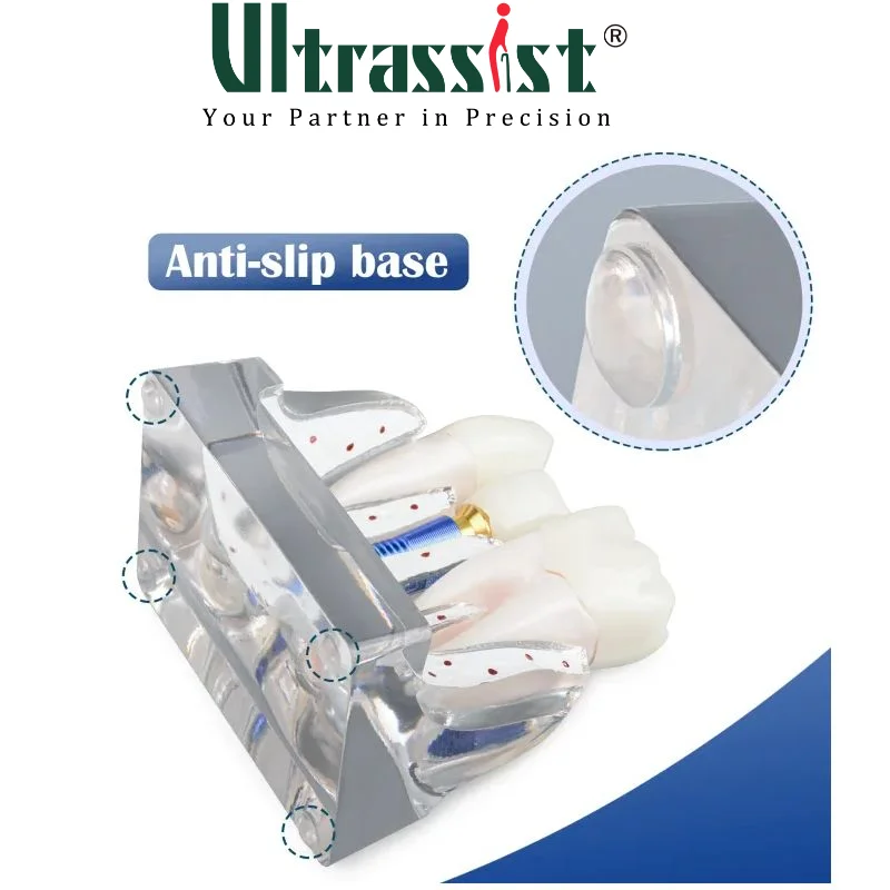 Ultrassist Dental Implant Model for Patient Education, 4 Times Dental Implant, Crown and Bridge Model for Presentation-Transpare