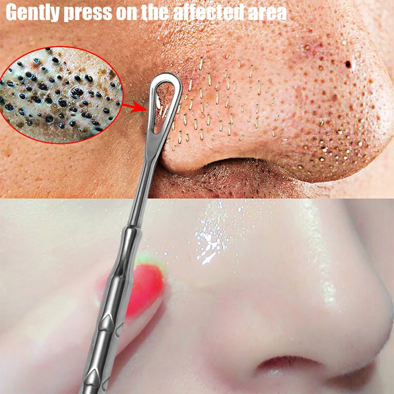 Mee-Eter Acne Verwijderen Naald Puistje Verwijderaar Popper Tool Whitehead Popping Pit, Neus Gezicht Vlek Extractor Huid Reiniging Tool