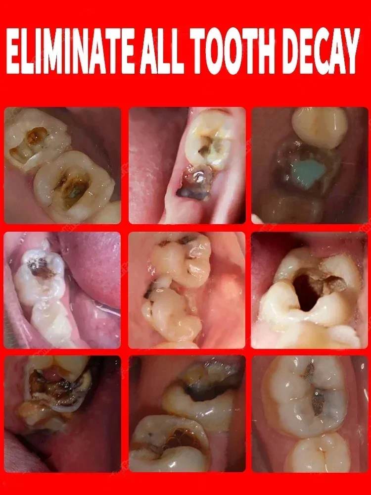 Dents filtrées pour éliminer temporairement la plaque dentaire, soulager les maux de dents