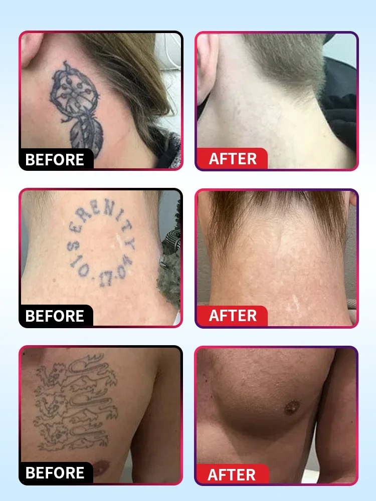 كريم إزالة الوشم، مناسب للوشم الكبير والصغير، فعال في إزالة الوشم الدائم