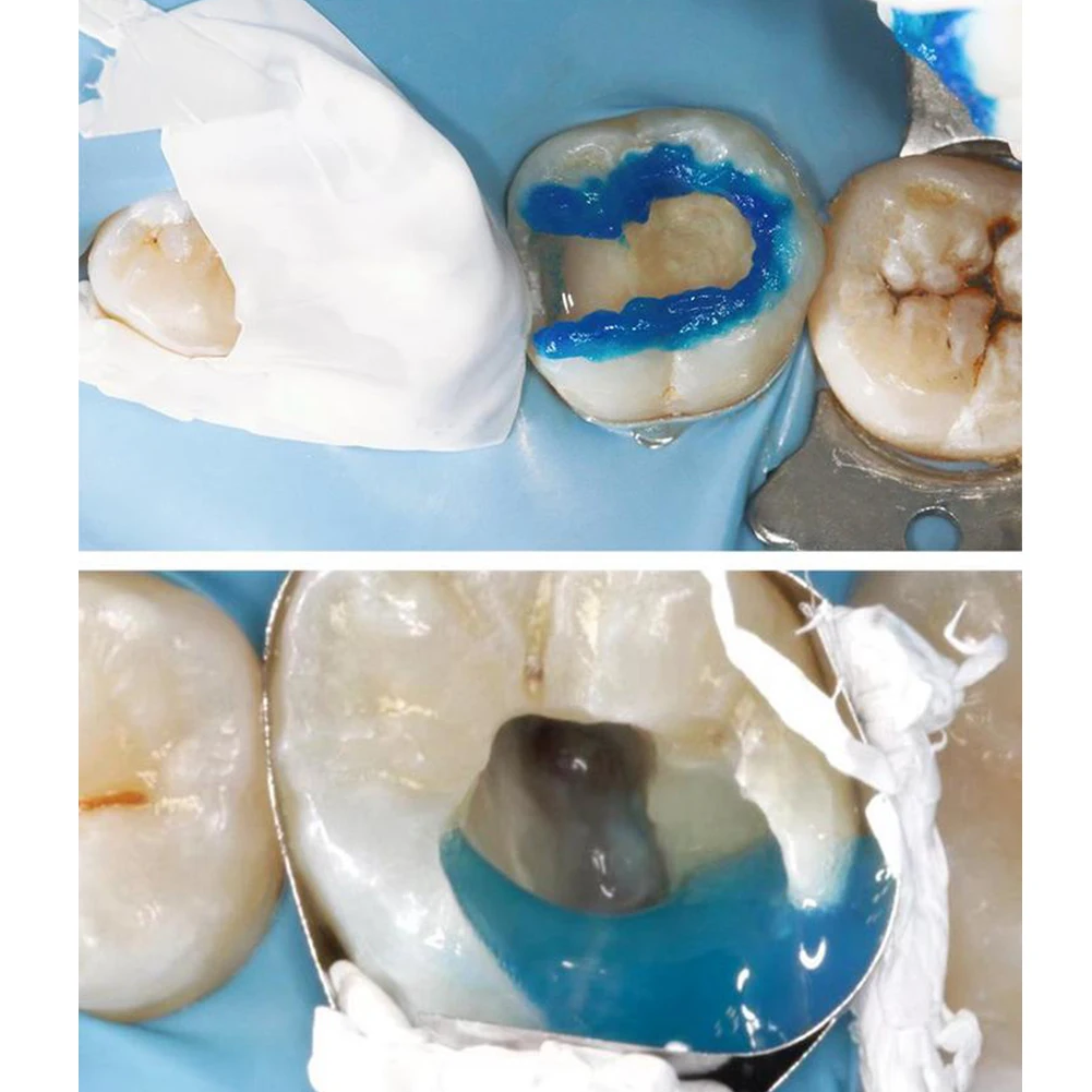 Dental Teflon Matrix Bands PTFE Rohstoff Gürtel Mit Cutter Schnitt Matrix System Tulwar Wedge Refill Wedge Zahnarzt Material – Detail 7