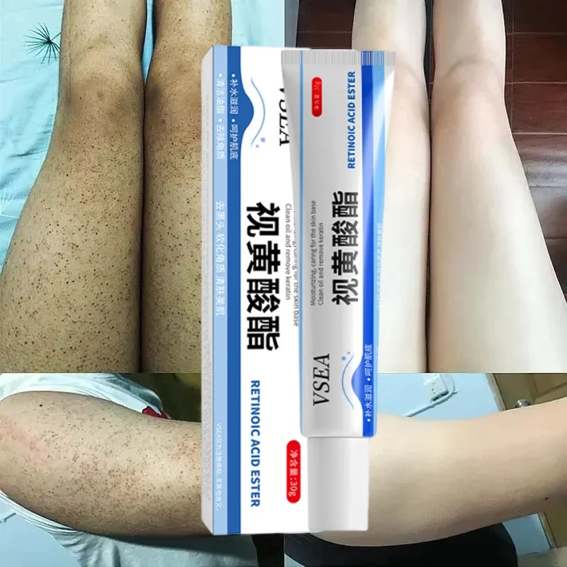 

Body Whitening Cream Keratosis Pilaris Treatment Bumpy Rough Chicken Follicle Skin Repair Strawberry Legs Removal Dry Skin Care
