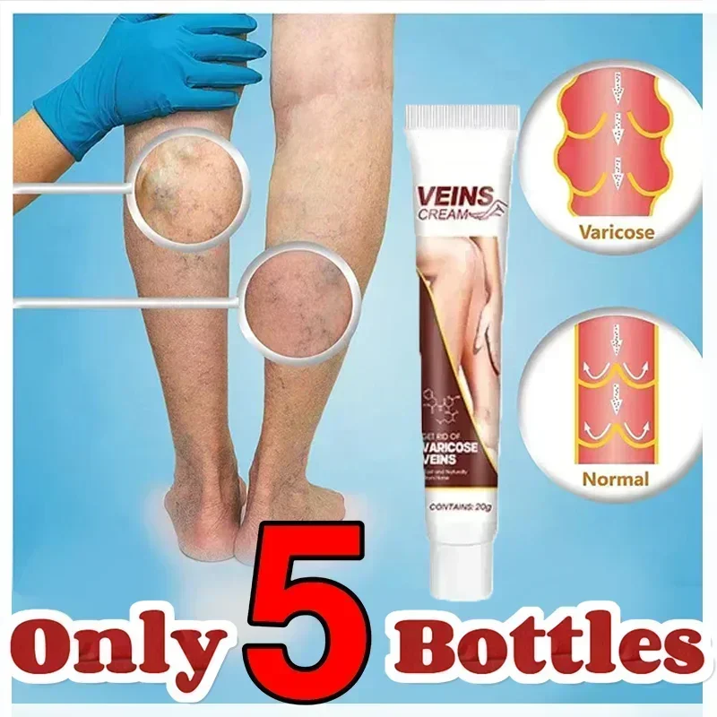 Мазь для устранения варикозного расширения вен, лечение боли в ногах, травяной крем