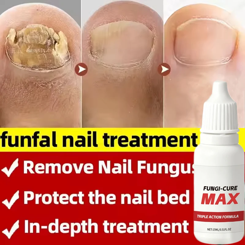 Nail Fungus Treatment Serum Treatment Toe Nails Fungal Removal Essential Oil Anti Infection Paronychia Onychomycosis Health Care