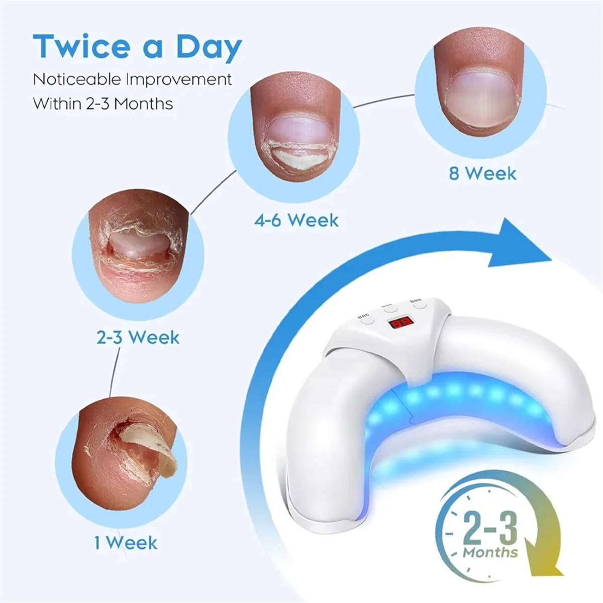 BABQ Dispositivo de tratamiento láser para hongos en las uñas, tratamiento de hongos en las uñas, onicomicosis, elimina eficazmente la onicomicosis, crecen las uñas de los pies