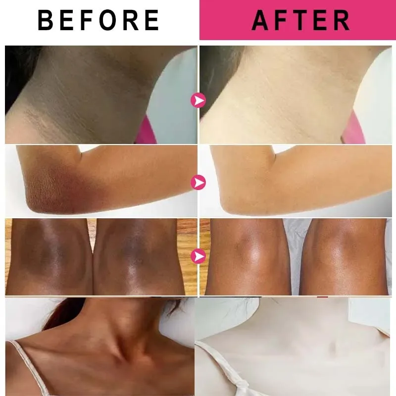 Armpit Whitening Cream Private Parts Dark Skin Bleaching Lighten Melanin  Nipple Brighten Thigh Whiten Butt Knee Stick Skin Care