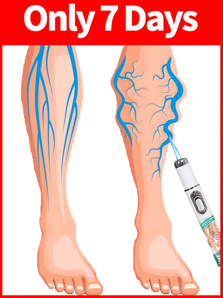 

laser for varicose veins effective treatment varicose vein laser remove varicose veins in 7 days
