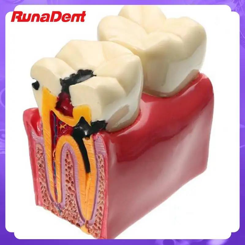 

6 Times Dental Caries Model of Contrast Dental Disease Teaching Study Demonstration Simulation Models