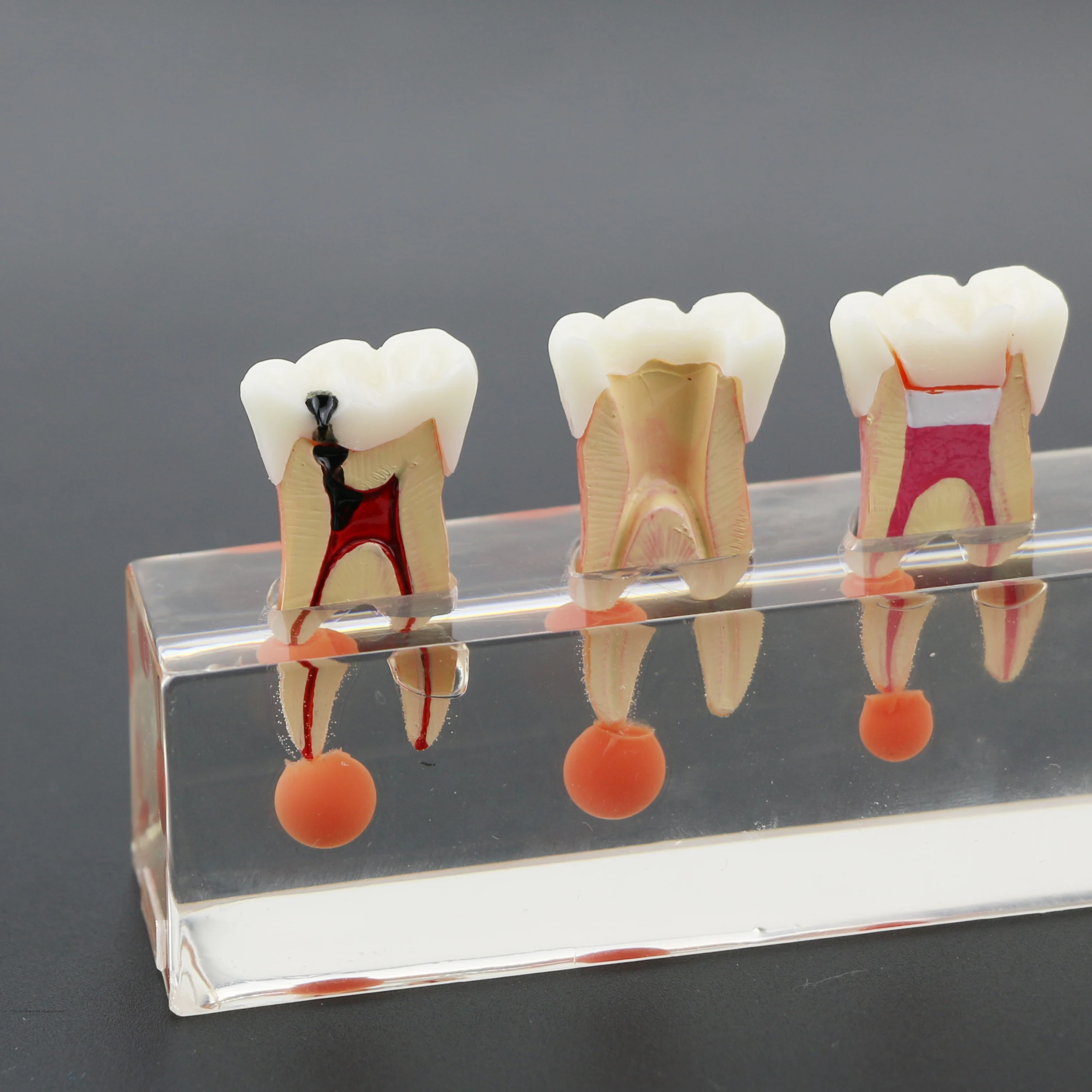 Model zębów dentystyczny M4018 Leczenie endodontyczne 4-etapowa próchnica kanału molowego do studiowania nauczania