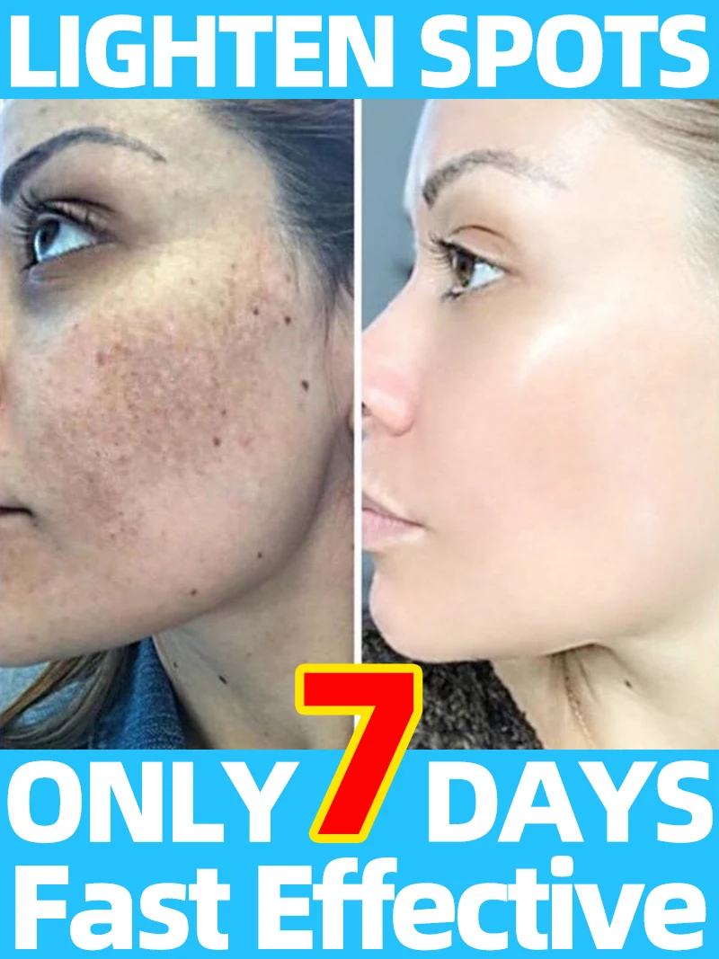 

Sun Age Dark Spot Chloasma Freckles Diminish