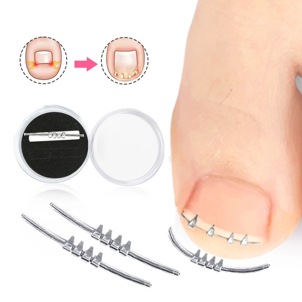 Ingrown Toenail Corrector Tool Embed Toe Nail Care Ingrown Toenail Pedicure Tool Curved Clamp Toenails Correction Tool