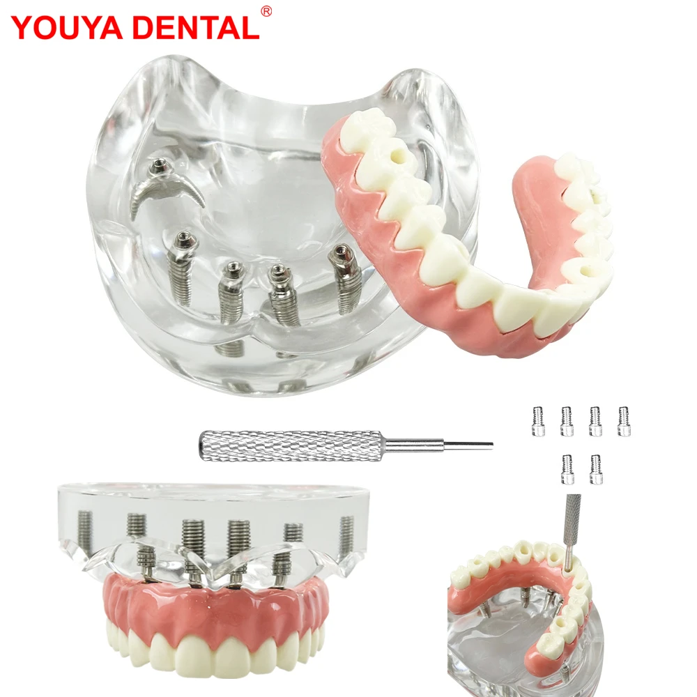 

Upper Jaw Dental Implant Model With 6 Implants Maxillary Removable Covered Denture For Teaching Studying Education Demonstration