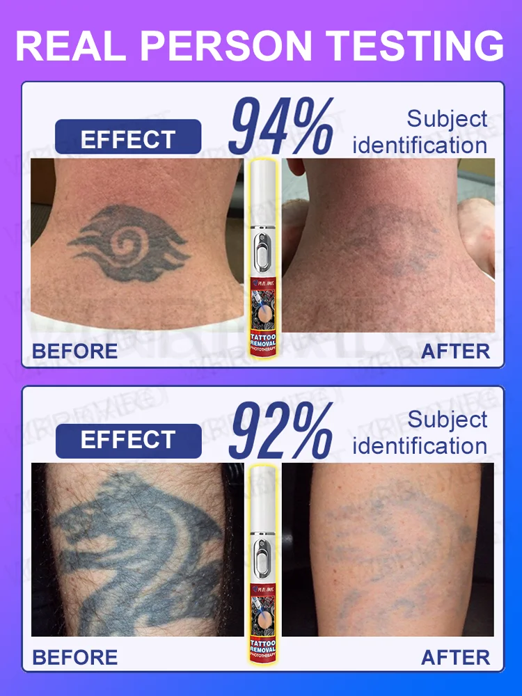 A ʟᴀsᴇʀ ᴘᴇɴ ᴛʜᴀᴛ ᴇғғᴇᴄᴛɪᴠᴇʟʏ ʀᴇᴍᴏᴠᴇs ᴛᴀᴛᴛᴏᴏs