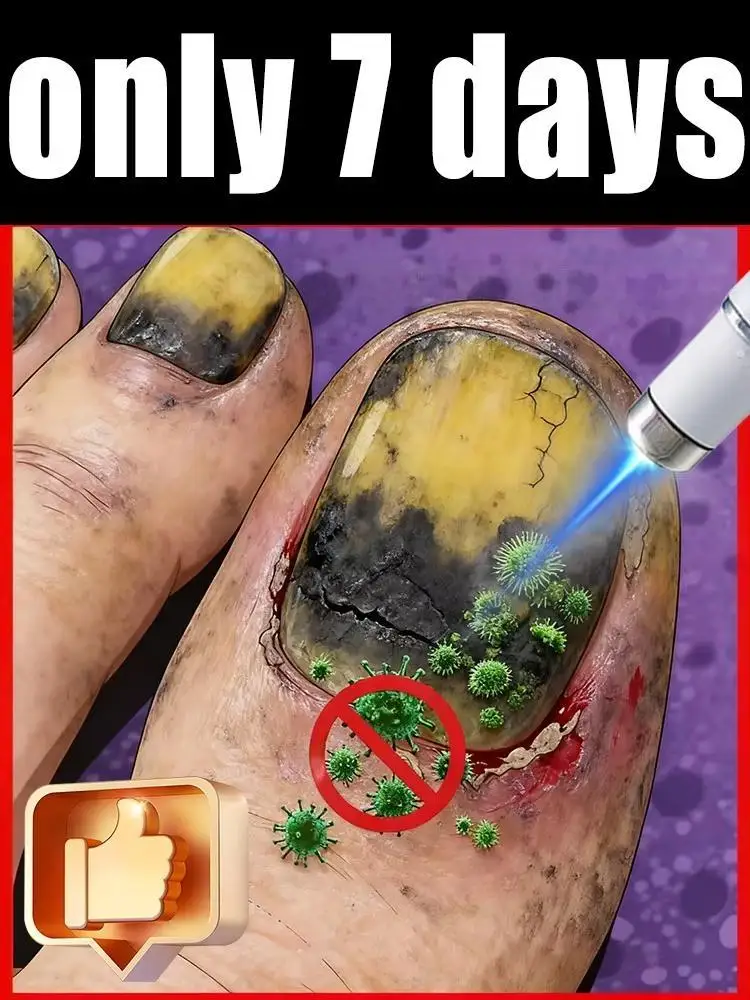 

The fifth generation of champagne-colored nail laser pen helps remove nail fungus, colorless and long-lasting sterilization