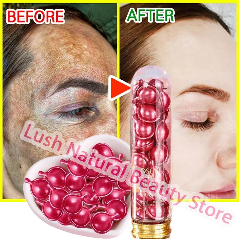 ﻿ Potente eliminador de manchas oscuras, cápsula blanqueadora, suero, crema, pecas, Corrector de melanina, Melasma, esencia iluminadora, cuidado hidratante