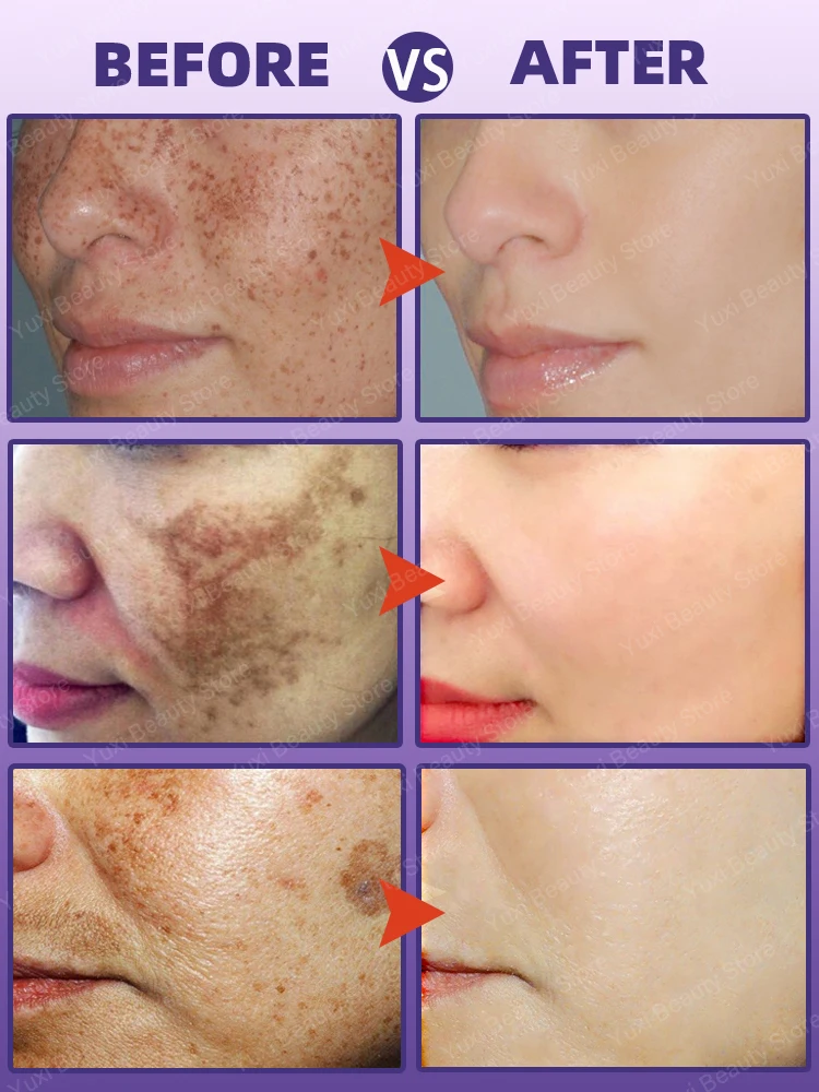 Creme de remoção de manchas escuras para rosto, melasma, sarda, idade, manchas solares, clareamento