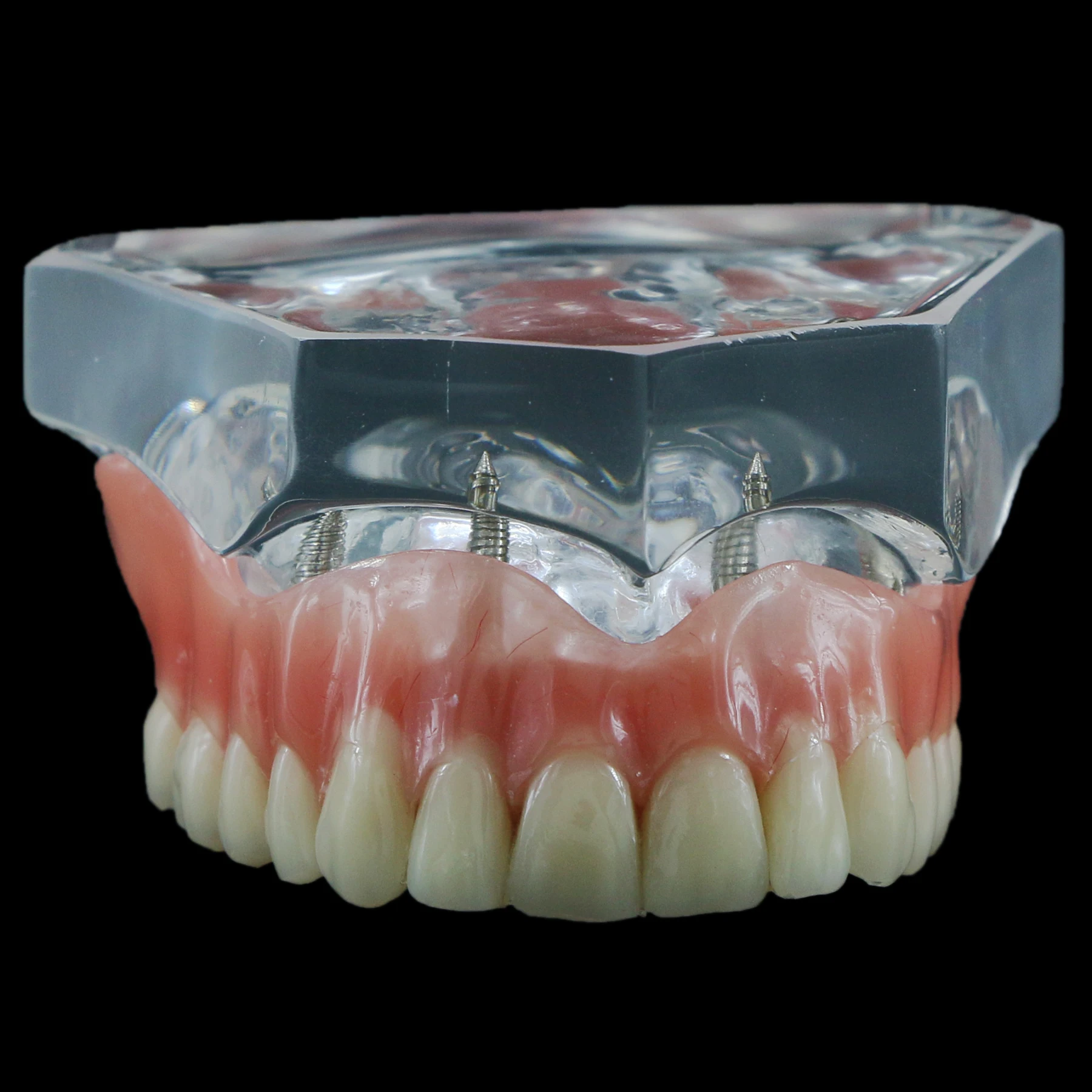 

Dental Upper Overdenture Superior 4 Implants Demo Model 6001C Teeth Model