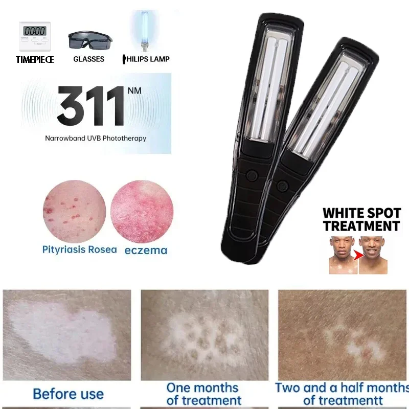 Home Use 311nm Narrowband UVB Light Therapy Pen Portable UV Lamp for Vitiligo Psoriasis Eczema Skin Pigment Care