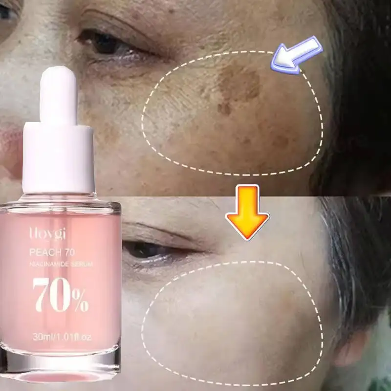 

Niacinamide Whitening Freckles Serum Removal Melasma Dark Spots Lighten Melanin Pigmentation Brightening Anti-Aging Beauty Care