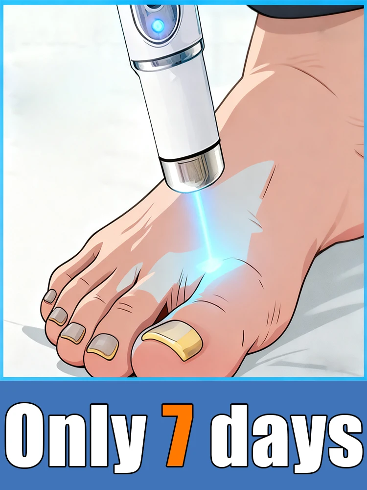 Niebieski długopis laserowy na grzybicę paznokci, popularne narzędzia do pielęgnacji paznokci z grzybicią.