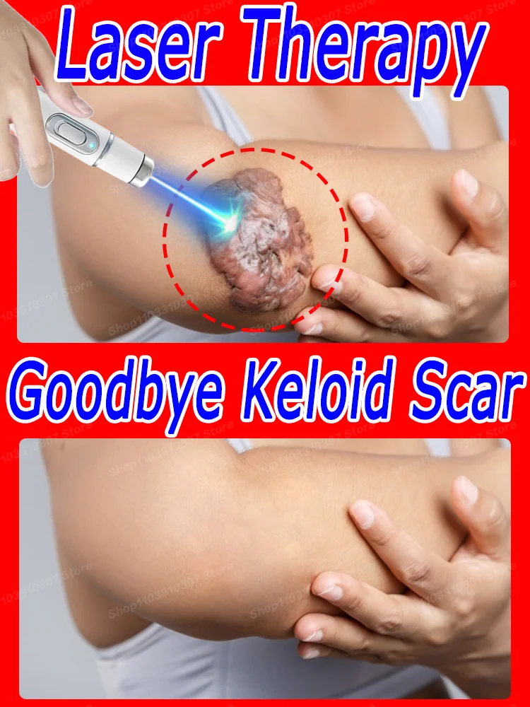 Laser Therapy Keloid scAR