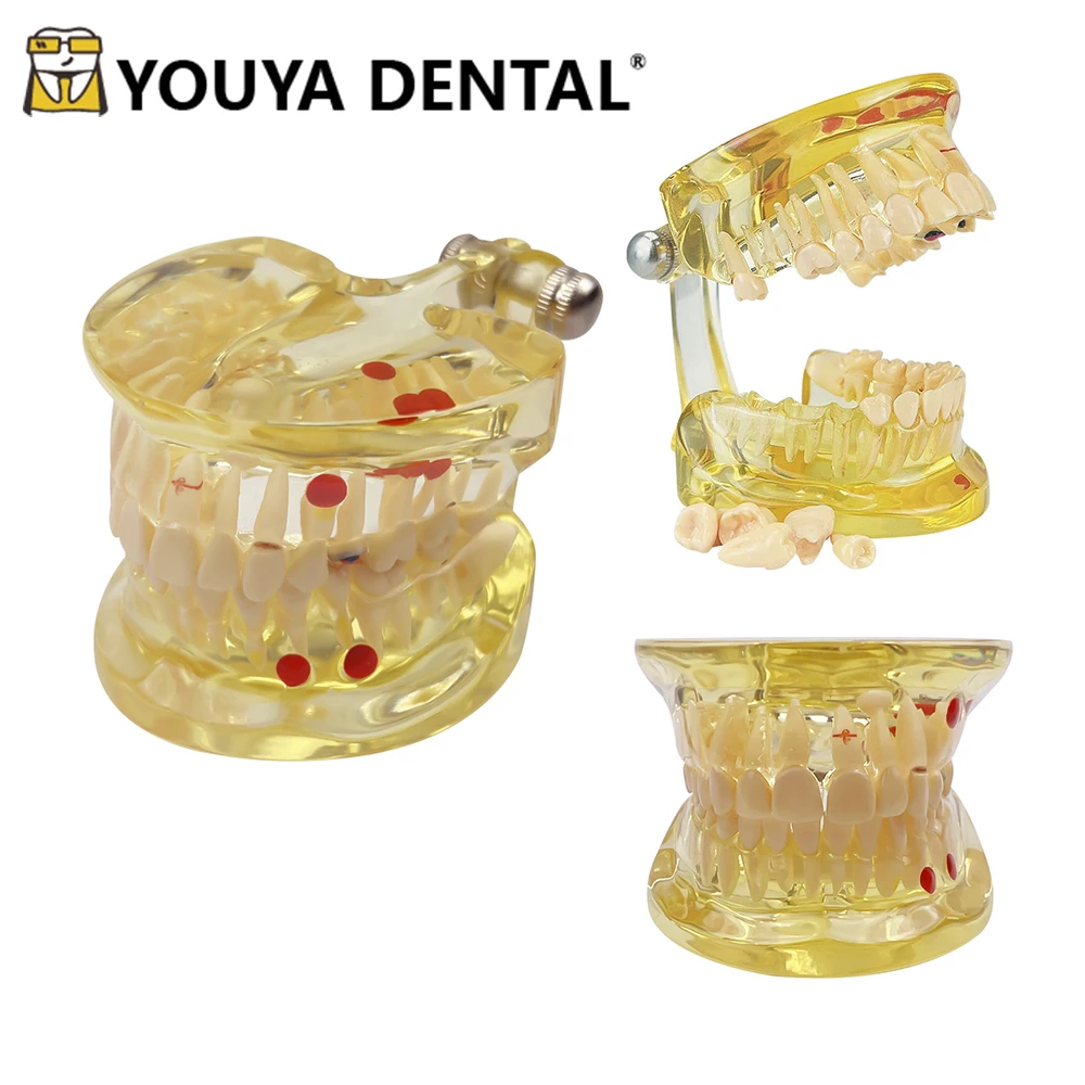 

Teeth Teaching Model Half Side Removable Pathology Model for Dental Student Practice Training Studying Models