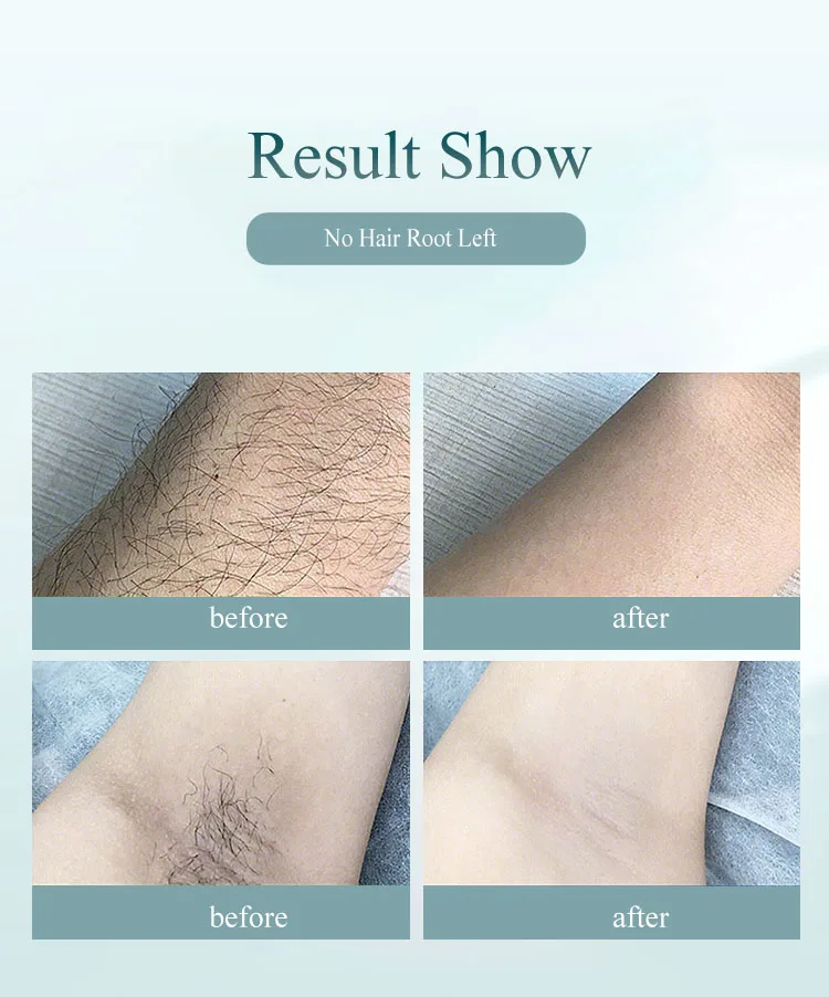 Handhold Laser Hair Removal 999900 Flash Painless Permanent for Women Men 8 Energy Levels Auto Bikini Trimmer Home IPL Epilator