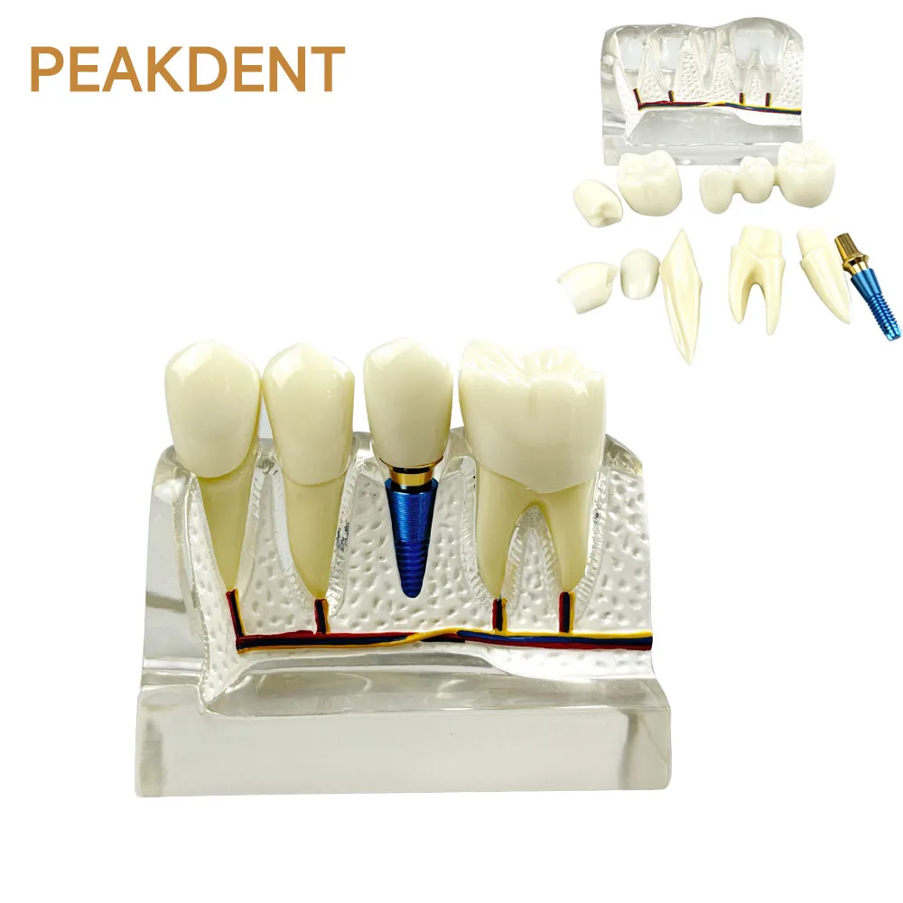 

Dental Implant Model Dental Demonstration Model Teaching Implant Analysis Crown Bridge Removable Model Teaching and Research Mod