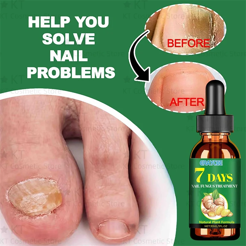 7 日間真菌爪治療血清足の爪真菌除去修復ジェル抗感染爪周囲炎爪真菌症足の爪ケア