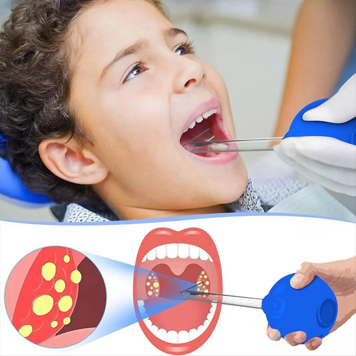 *A02R Aspirador removedor de piedras de amígdalas, kit removedor de piedras de amígdalas, herramienta de eliminación de piedras de amígdalas, limpieza bucal de estilo manual