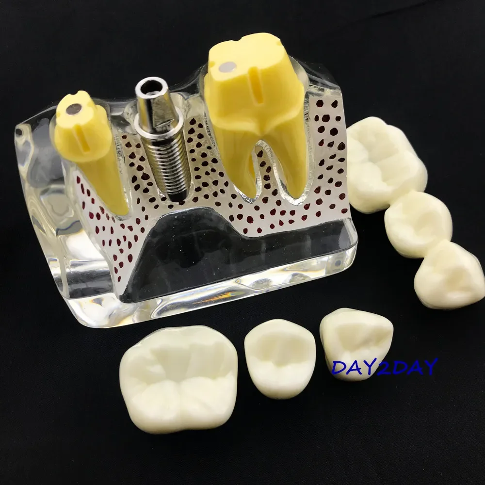 نموذج تعليمي عن طريق الفم # 2017X نموذج قابل للإزالة لجسر التاج لتعليم الأسنان نموذج لشكل الأسنان