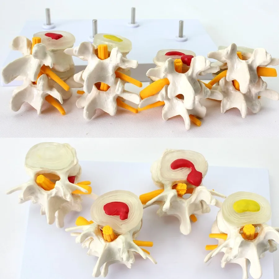 4 Part Lumbar Disc Herniation Demo Model Spine  Anatomy Model Medical Props Equipment