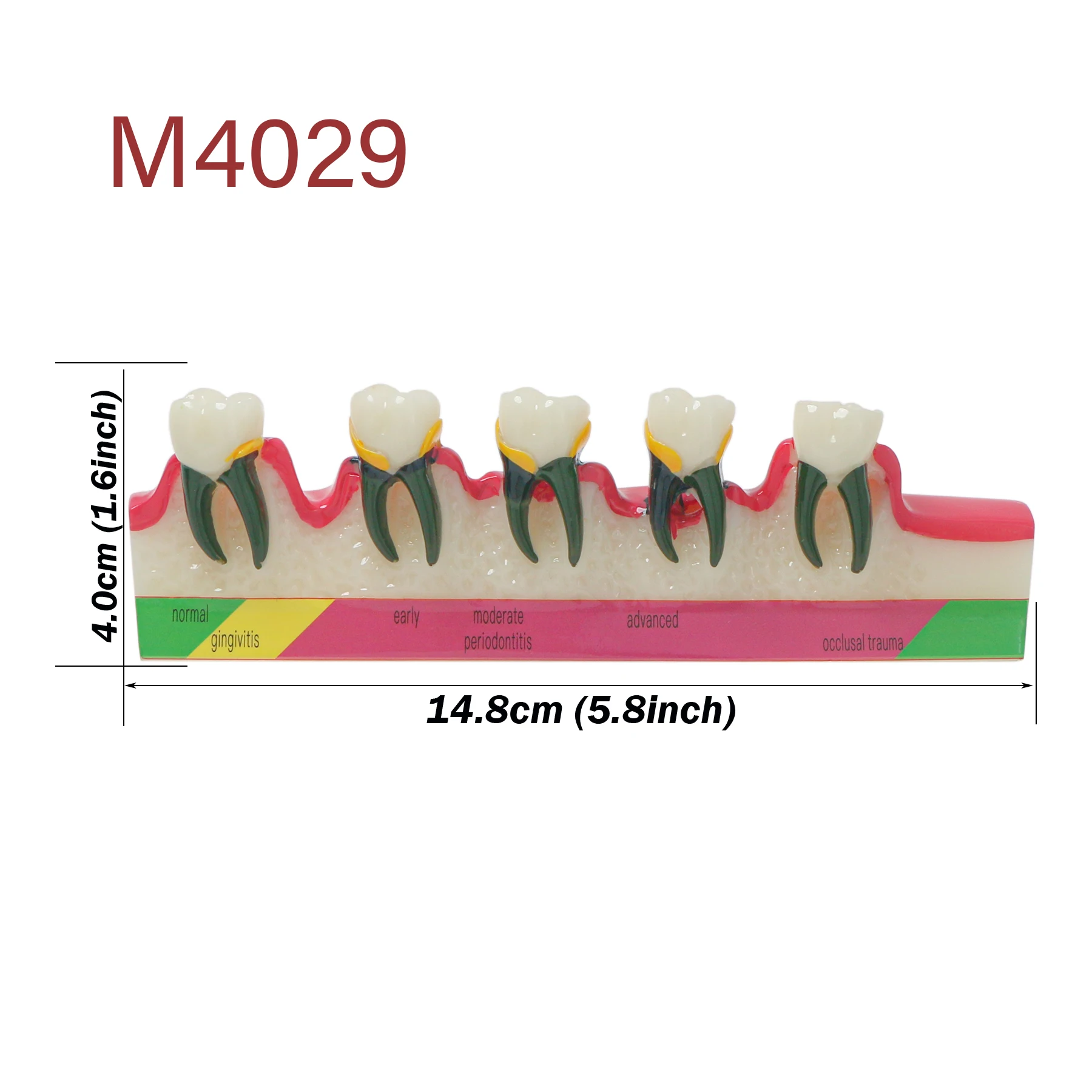 Dental Typodont Teeth Periodontal Disease Model Caries Disease Assort Demo Study Teaching Model for Dental Education M4029