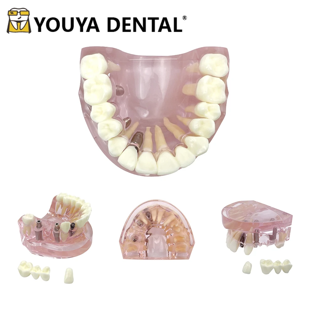 

Dental Teeth Model With Implants Overdenture Superior Demo Upper Jaw Removable Tooth Model For Teaching Education Studying