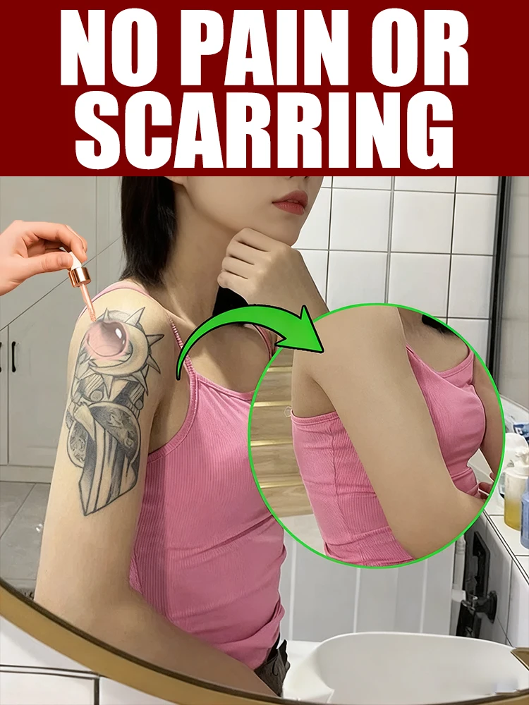 Rimuovi tatuaggi senza lasciare cicatrici e alleggeriscono la pigmentazione