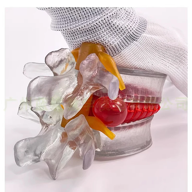 Demonstration model of medical human lumbar intervertebral disc compression Demonstration of pathological lateral compression of