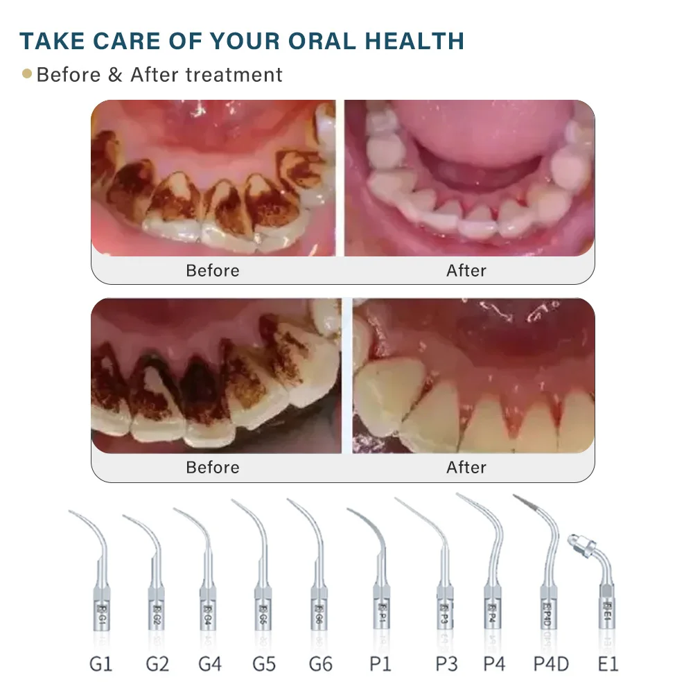 Dental ultrasonic scaler Cleaning of stains and calculus Equipped with LED water tank Pet-friendly