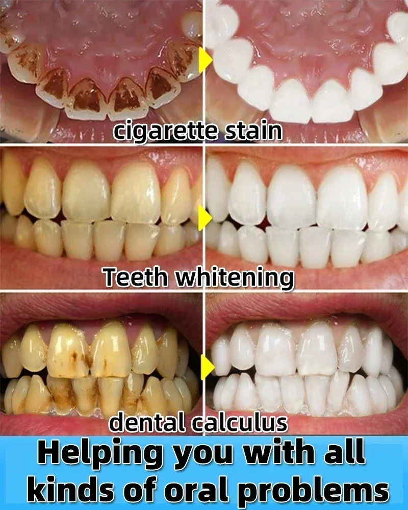 Dental Calculus Remover Spray Teeth Whitening Serum Remove Plaque Stains Halitosis Cleaning Oral Hygiene Fresh Bad Breath Care